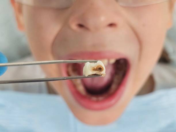 Best Emergency Dentist for Lost Fillings or Crowns in Port Ewen, NY